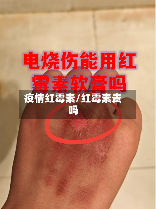 疫情红霉素/红霉素贵吗
