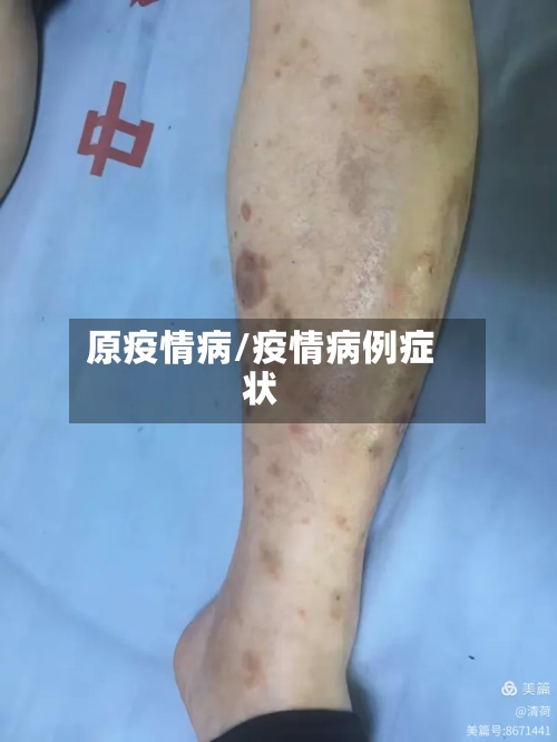 原疫情病/疫情病例症状-第2张图片